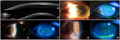 Case report: Squamous cell carcinoma in situ of the cornea without involvement of the limbus and conjunctiva